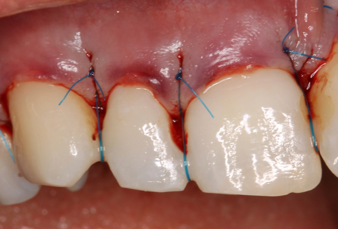04/07 botiss mucoderm® for coverage of multiple recessions - clinical case by Dr. S. Stavar