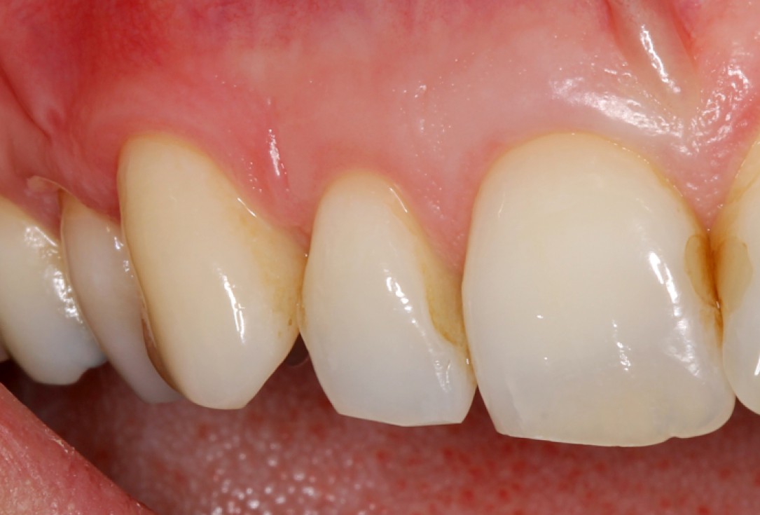 07/07 botiss mucoderm® for coverage of multiple recessions - clinical case by Dr. S. Stavar