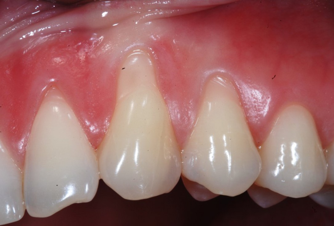 botiss-mucoderm-recession-coverage-Rakasevic-1