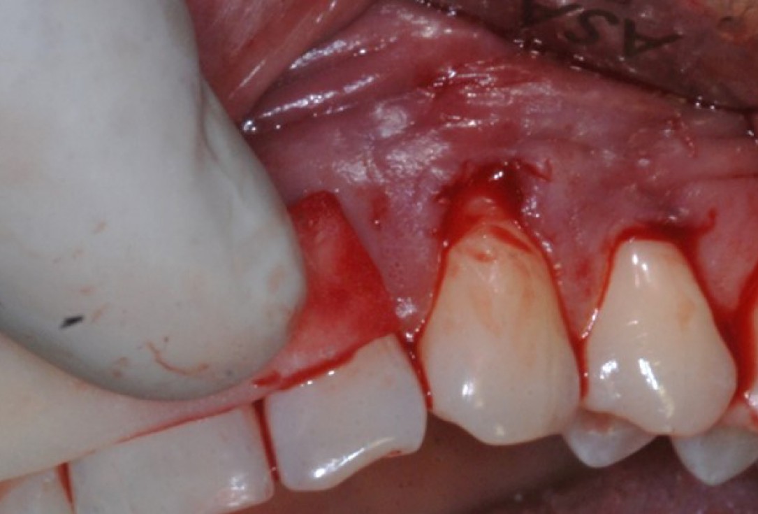 botiss-mucoderm-recession-coverage-Rakasevic-3