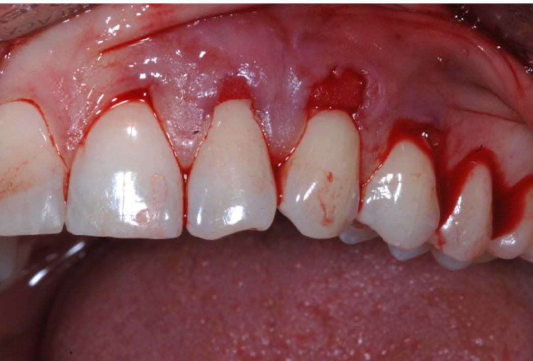 botiss-mucoderm-recession-coverage-Rakasevic-4