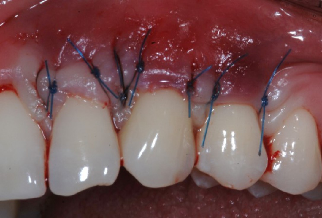 botiss-mucoderm-recession-coverage-Rakasevic-5