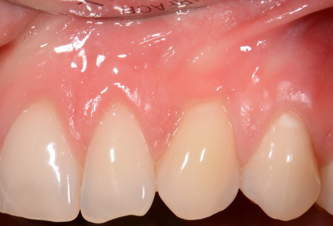 botiss-mucoderm-recession-coverage-Rakasevic-7