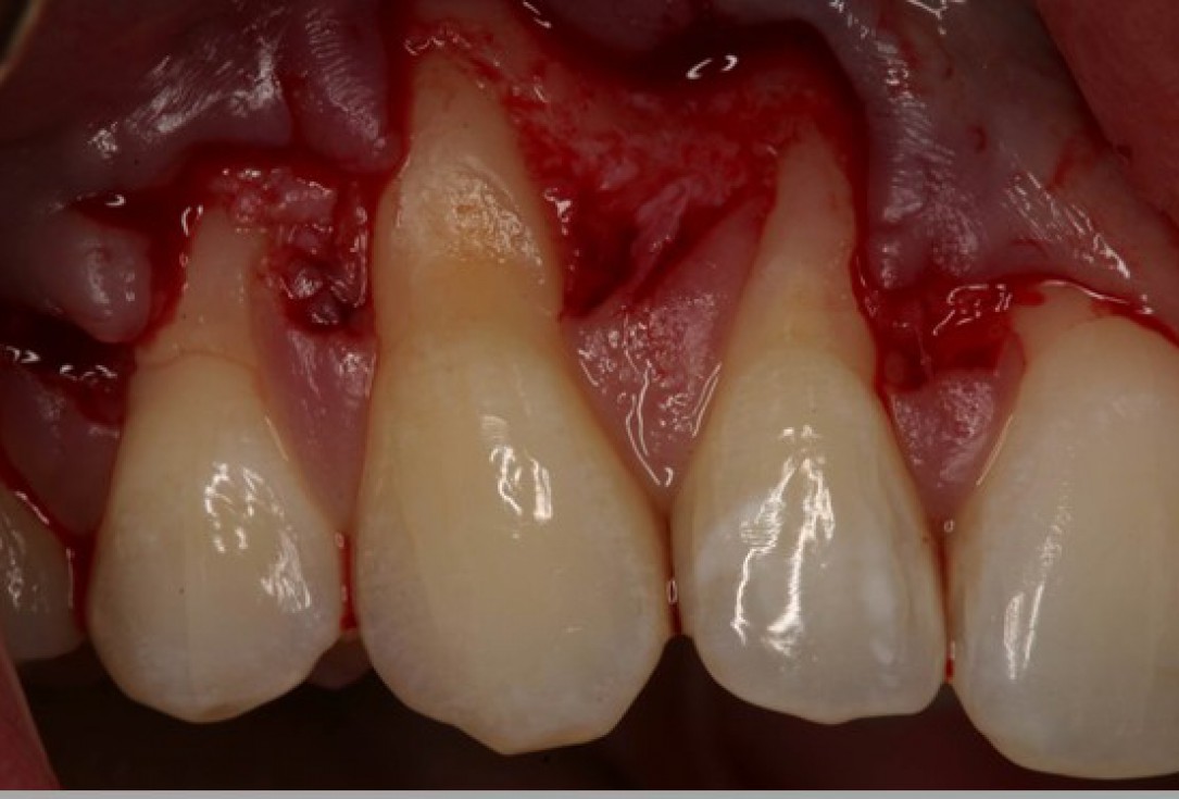 Multiple gingival recessions treated by MCAF in conjunction with mucoderm® - Kasaj