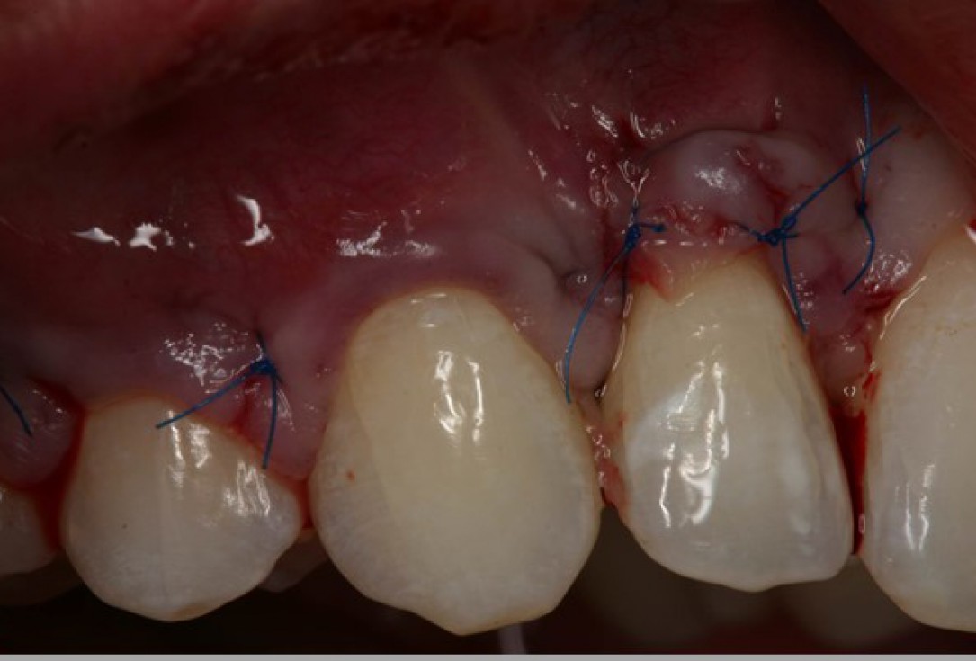 Multiple gingival recessions treated by MCAF in conjunction with mucoderm® - Kasaj