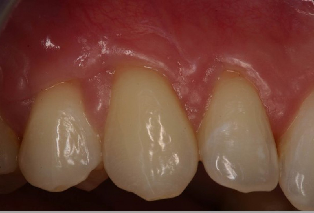 Multiple gingival recessions treated by MCAF in conjunction with mucoderm® - Kasaj