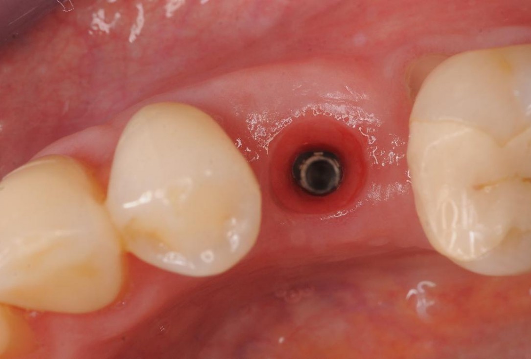 Gingival contour augmentation- Hangyási