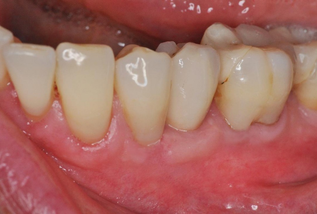 Gingival contour augmentation- Hangyási