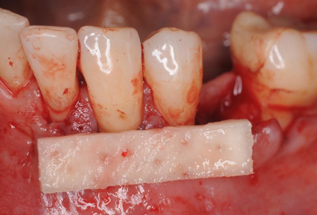 Gingival contour augmentation- Hangyási
