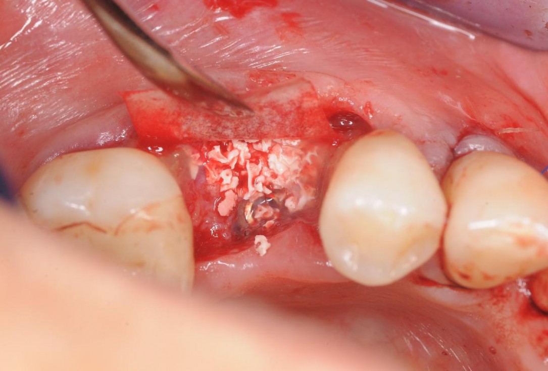 Gingival contour augmentation- Hangyási