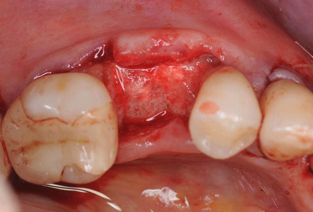 Gingival contour augmentation- Hangyási