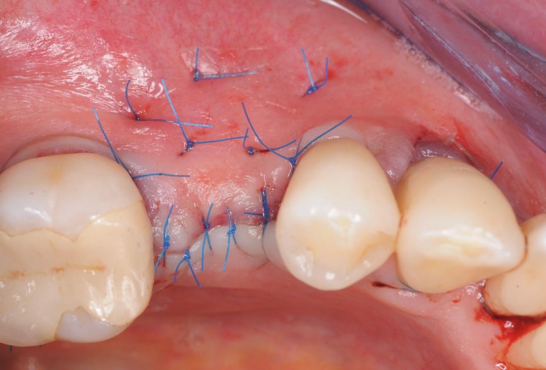 Gingival contour augmentation- Hangyási