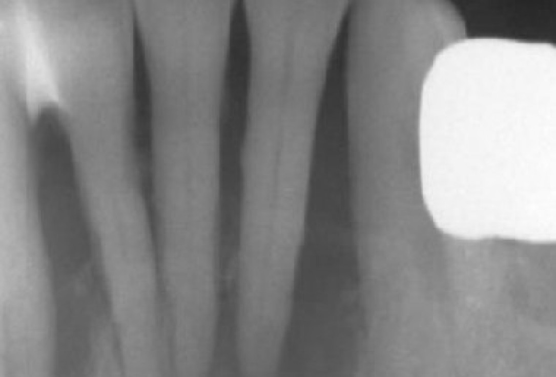 1/15 Soft tissue augmentation with GBR-Scherg