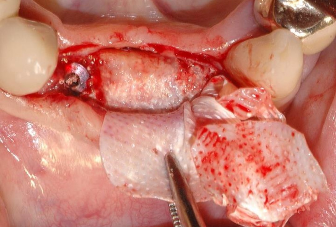 10/15 Soft tissue augmentation with GBR-Scherg