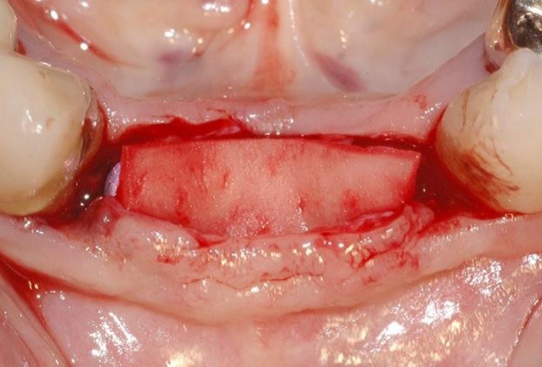 11/15 Soft tissue augmentation with GBR-Scherg