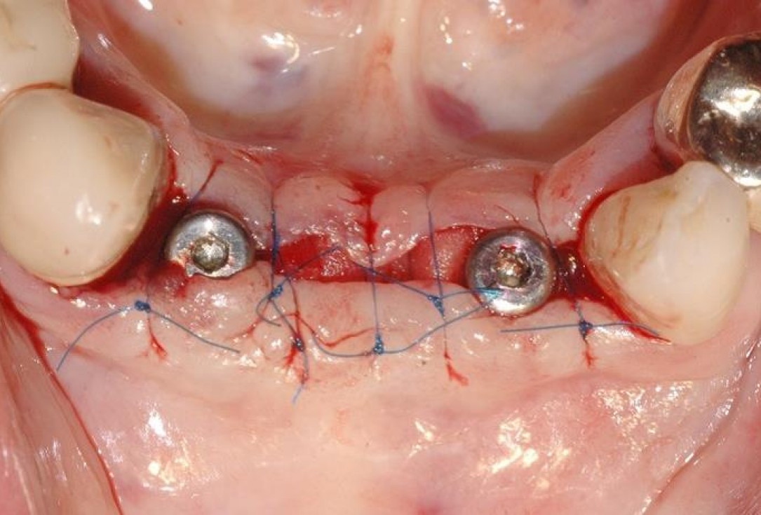 12/15 Soft tissue augmentation with GBR-Scherg