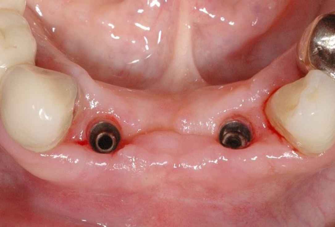 13/15 Soft tissue augmentation with GBR-Scherg