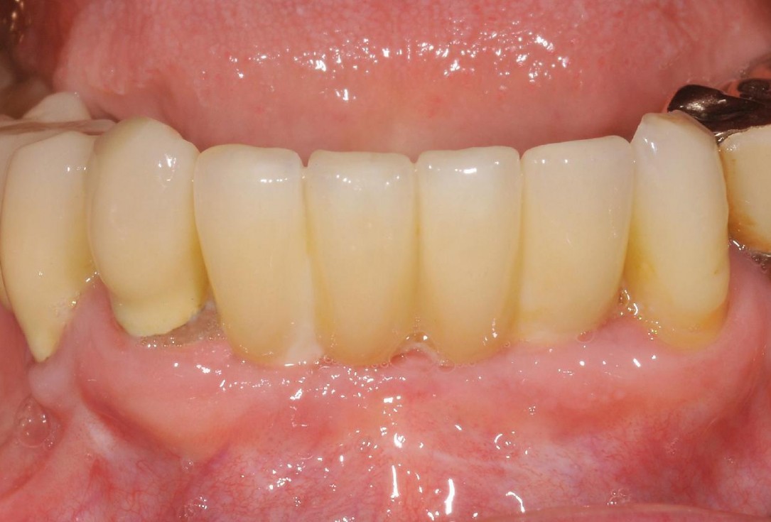 15/15 Soft tissue augmentation with GBR-Scherg