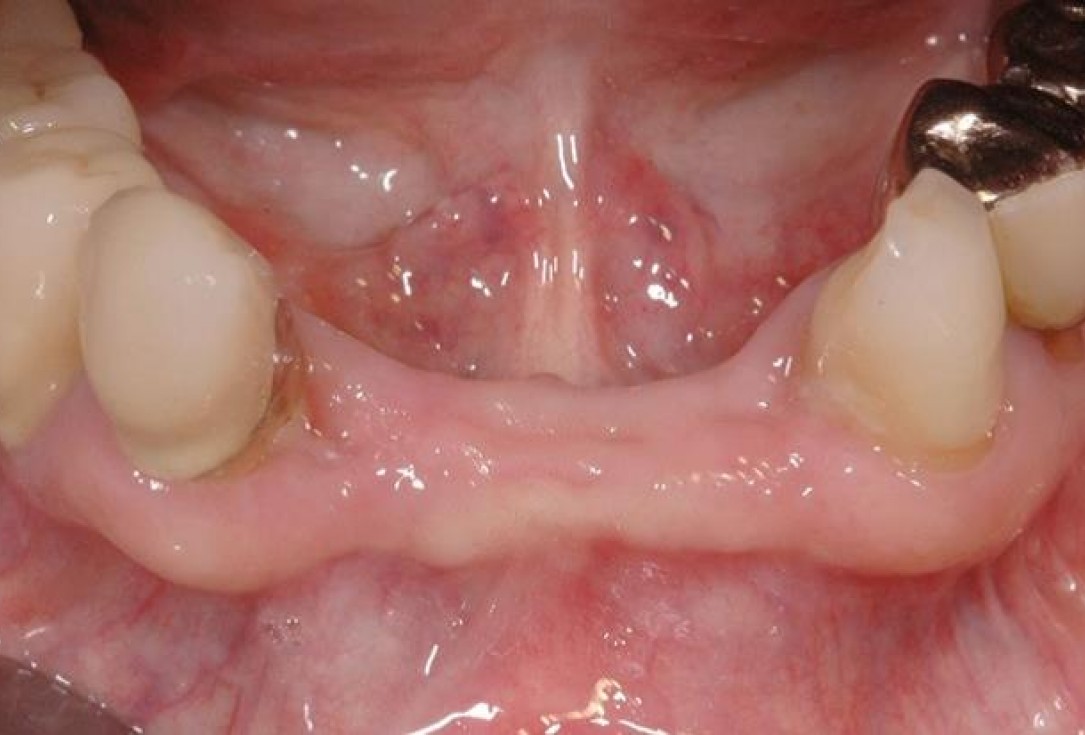 2/15 Soft tissue augmentation with GBR-Scherg