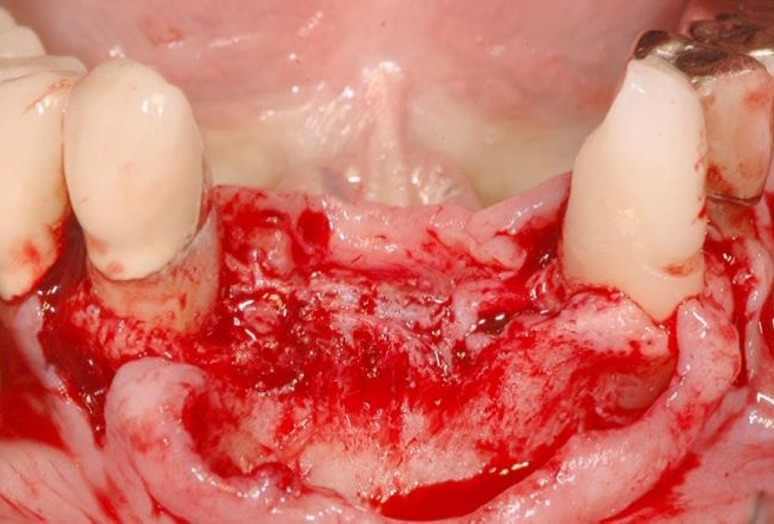 3/15 Soft tissue augmentation with GBR-Scherg