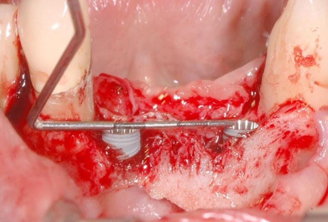 4/15 Soft tissue augmentation with GBR-Scherg