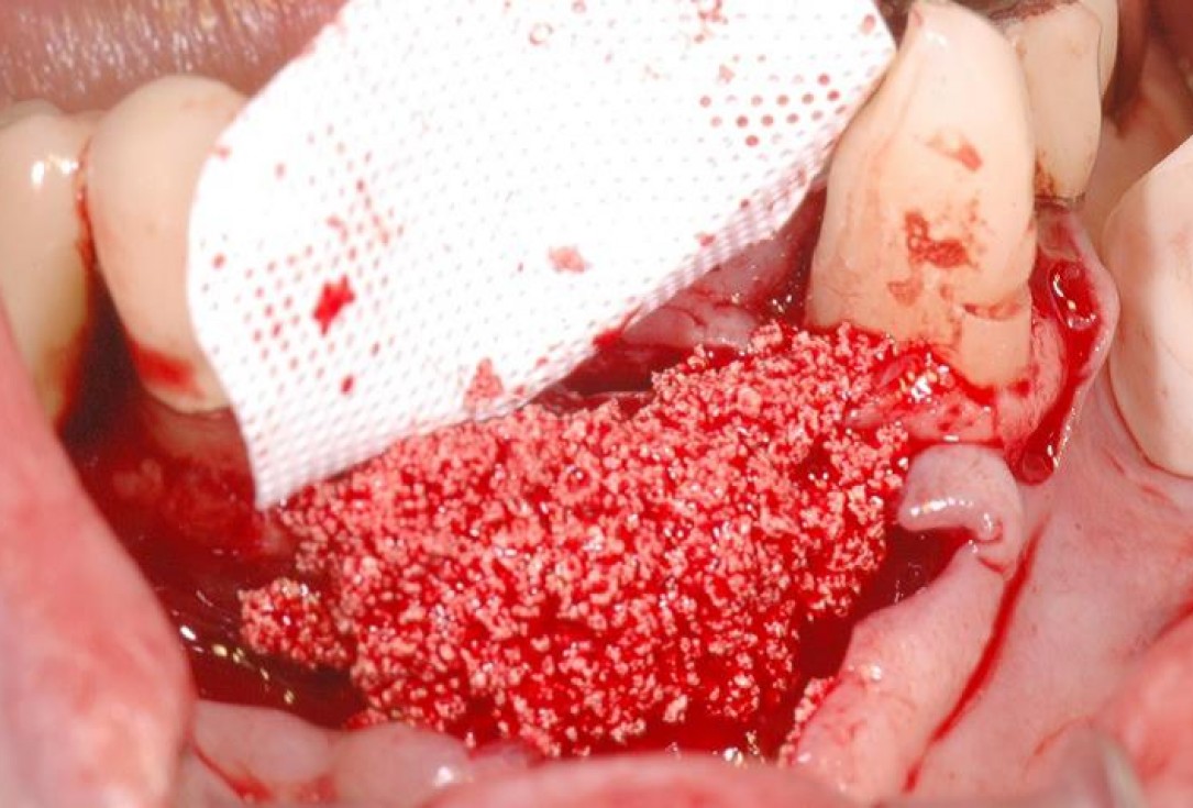 5/15 Soft tissue augmentation with GBR-Scherg