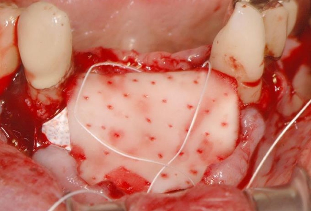 6/15 Soft tissue augmentation with GBR-Scherg