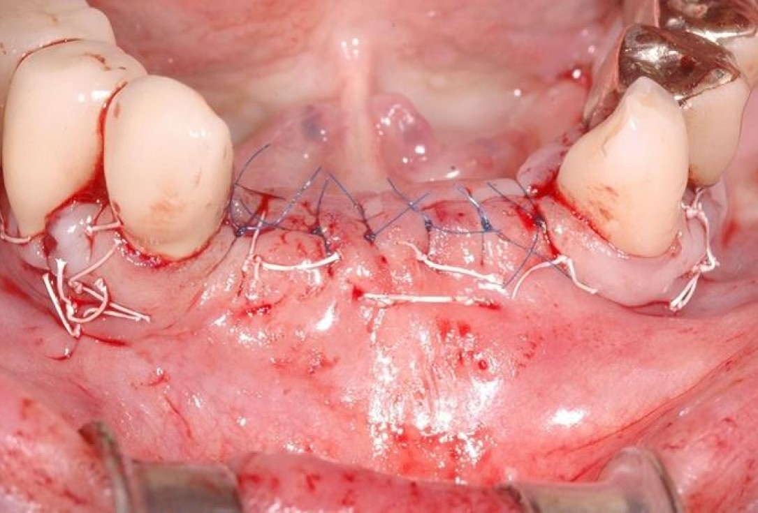 7/15 Soft tissue augmentation with GBR-Scherg