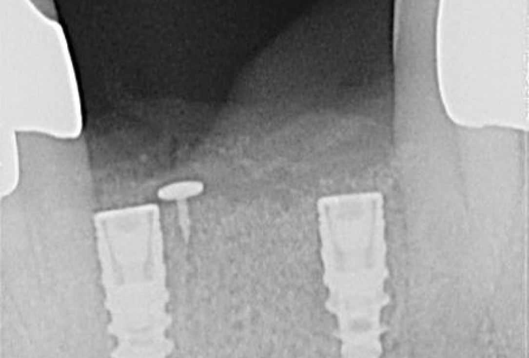 8/15 Soft tissue augmentation with GBR-Scherg