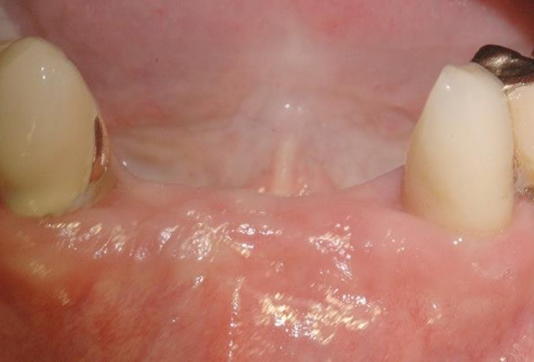 9/15 Soft tissue augmentation with GBR-Scherg