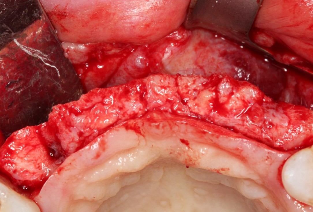 Soft tissue augmentation following ridge splitting- Rathe