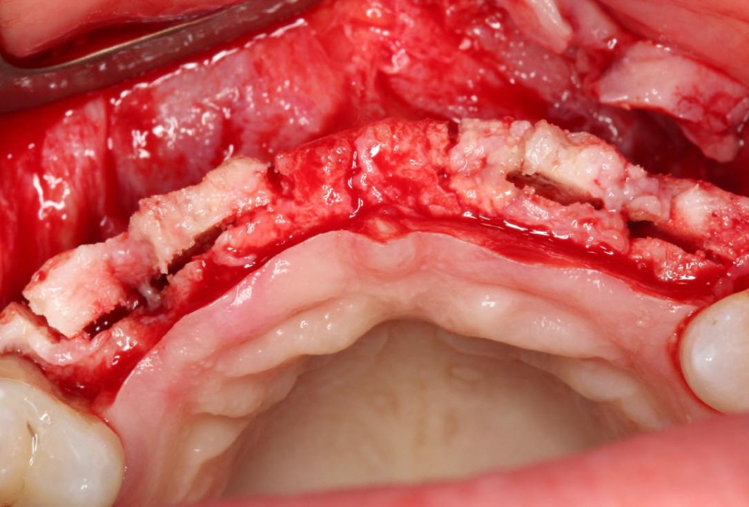 Soft tissue augmentation following ridge splitting- Rathe