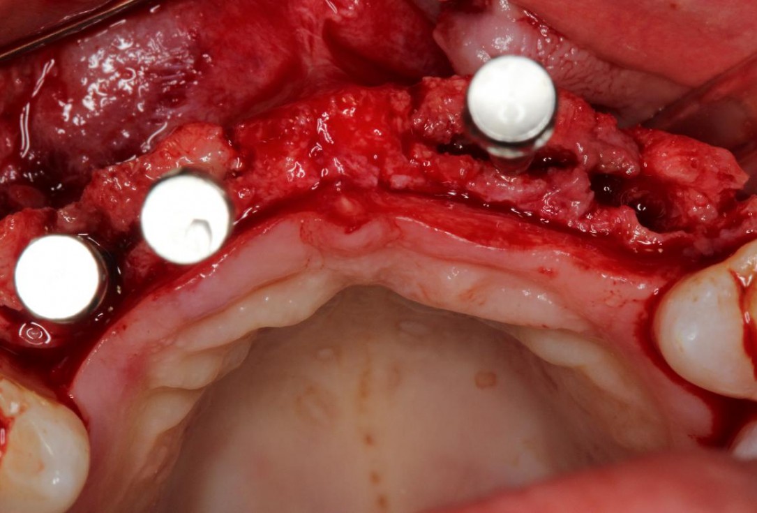 Soft tissue augmentation following ridge splitting- Rathe