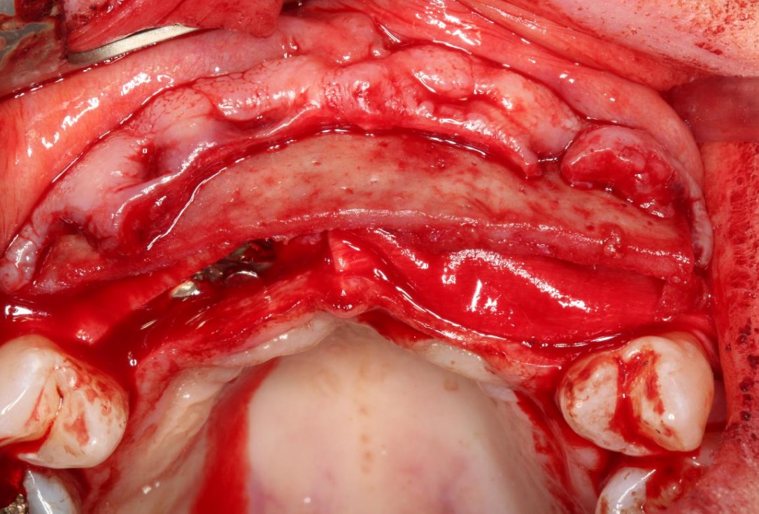 Soft tissue augmentation following ridge splitting- Rathe