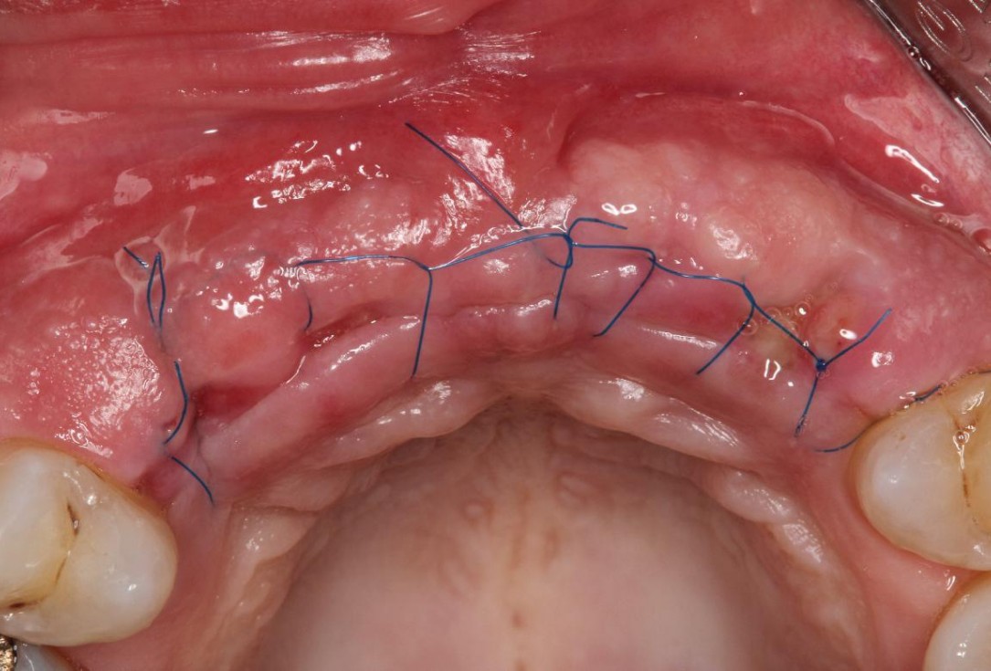 Soft tissue augmentation following ridge splitting- Rathe