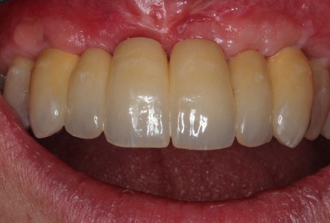 Soft tissue augmentation following ridge splitting- Rathe