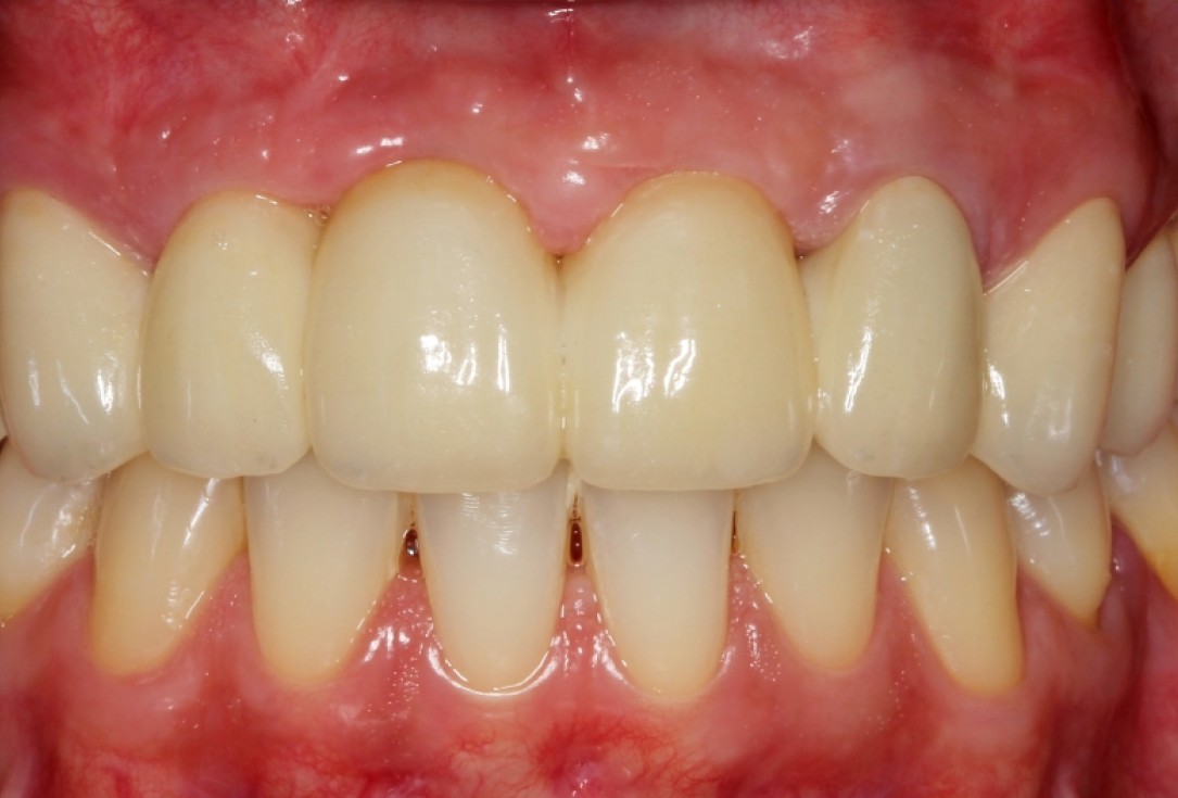 botiss mucoderm® in soft tissue augmentation for pontic- Stavar