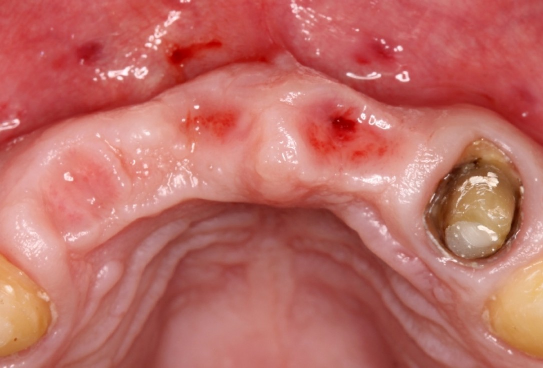 botiss mucoderm® in soft tissue augmentation for pontic- Stavar