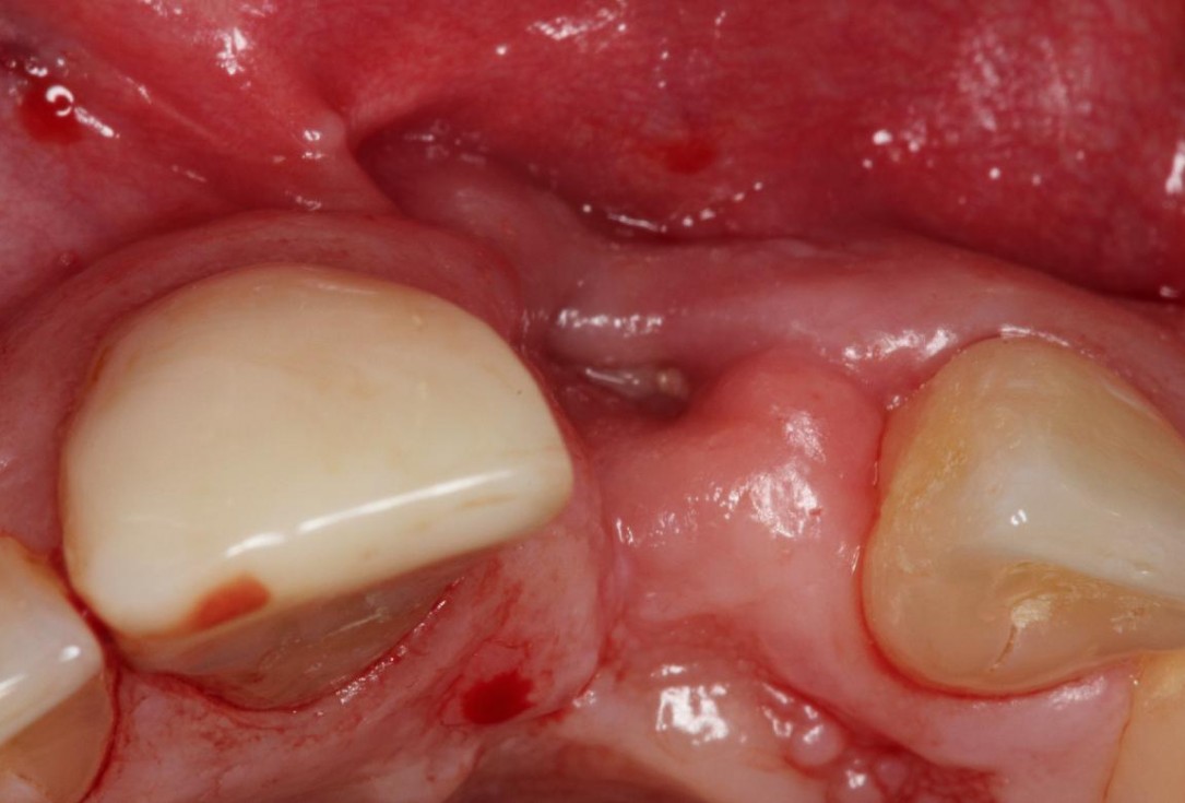 1/7 Augmentation of a traumatic soft tissue defect-Rathe