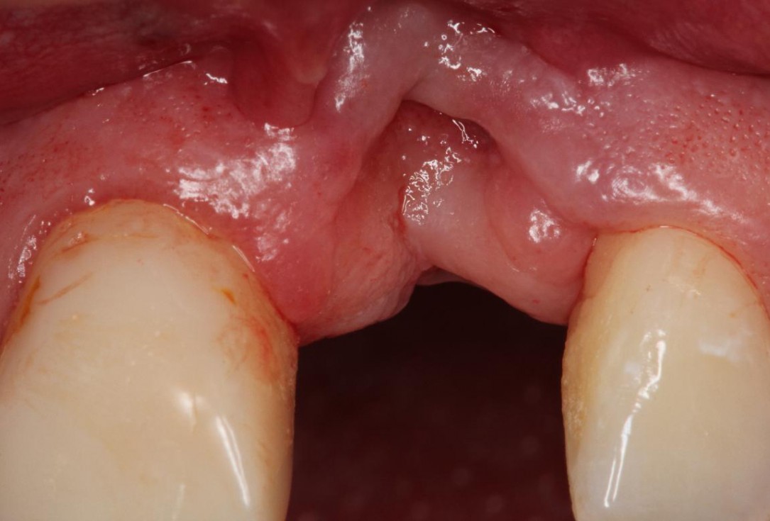 2/7 Augmentation of a traumatic soft tissue defect-Rathe