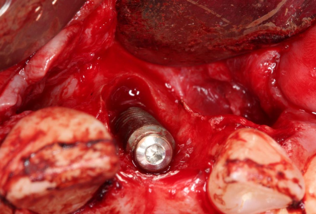 3/7 Augmentation of a traumatic soft tissue defect-Rathe