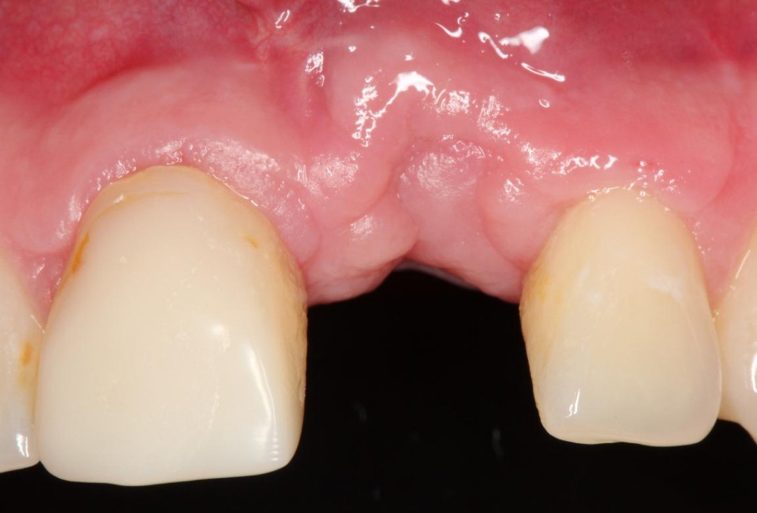 4/7 Augmentation of a traumatic soft tissue defect-Rathe
