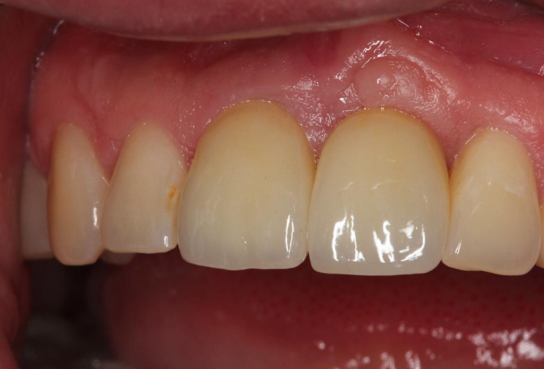 7/7 Augmentation of a traumatic soft tissue defect-Rathe