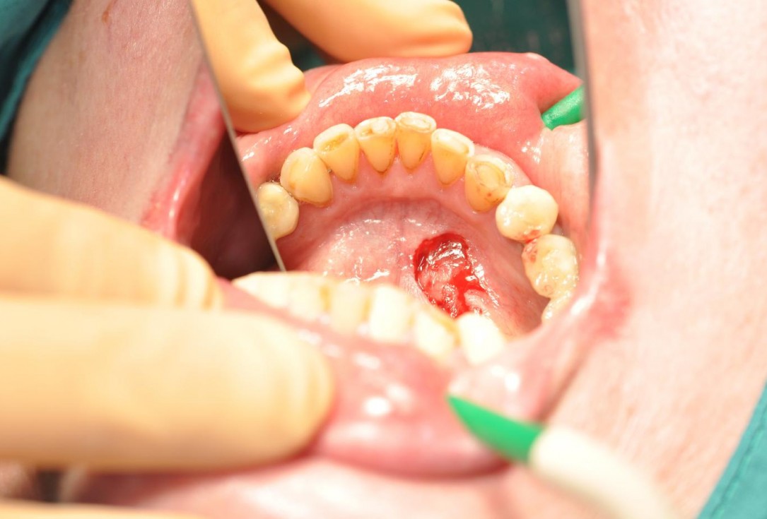 Soft tissue augmentation after resective surgery- Kämmerer