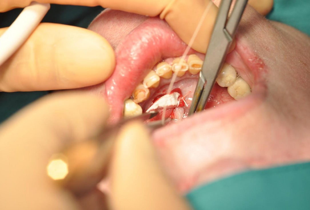 Soft tissue augmentation after resective surgery- Kämmerer