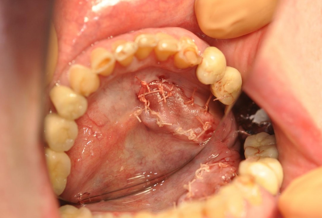 Soft tissue augmentation after resective surgery- Kämmerer
