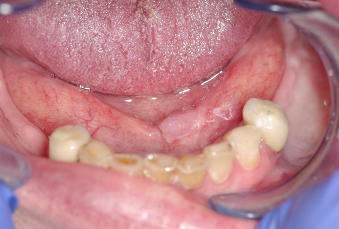 Soft tissue augmentation after resective surgery- Kämmerer