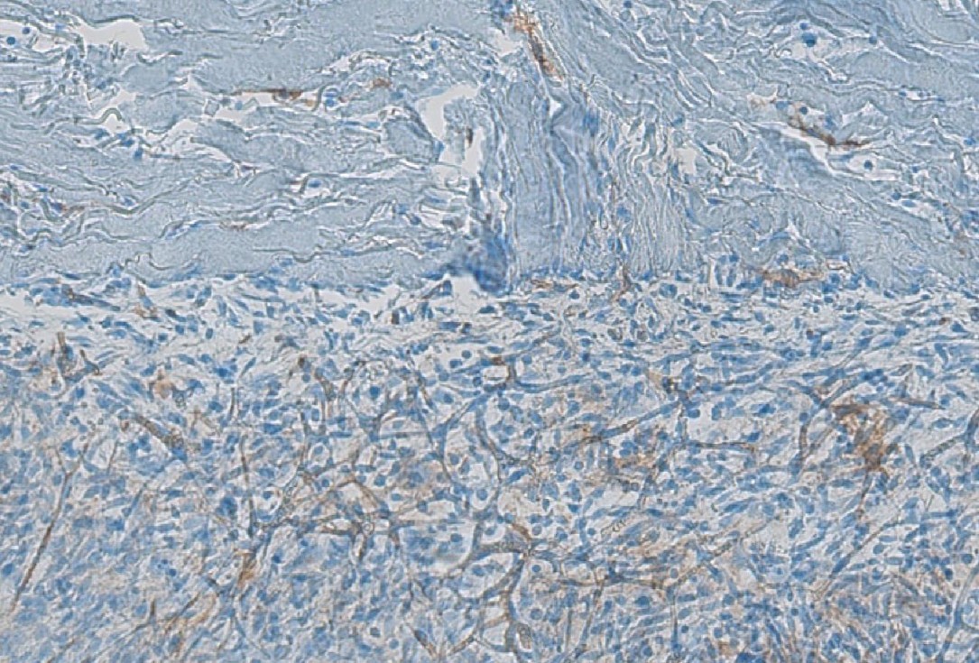 Soft tissue augmentation after resective surgery- Kämmerer