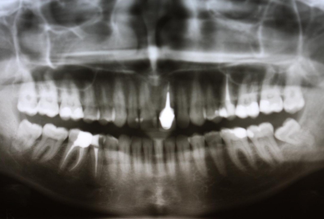 Soft tissue thickening at early implant placement-Puisys