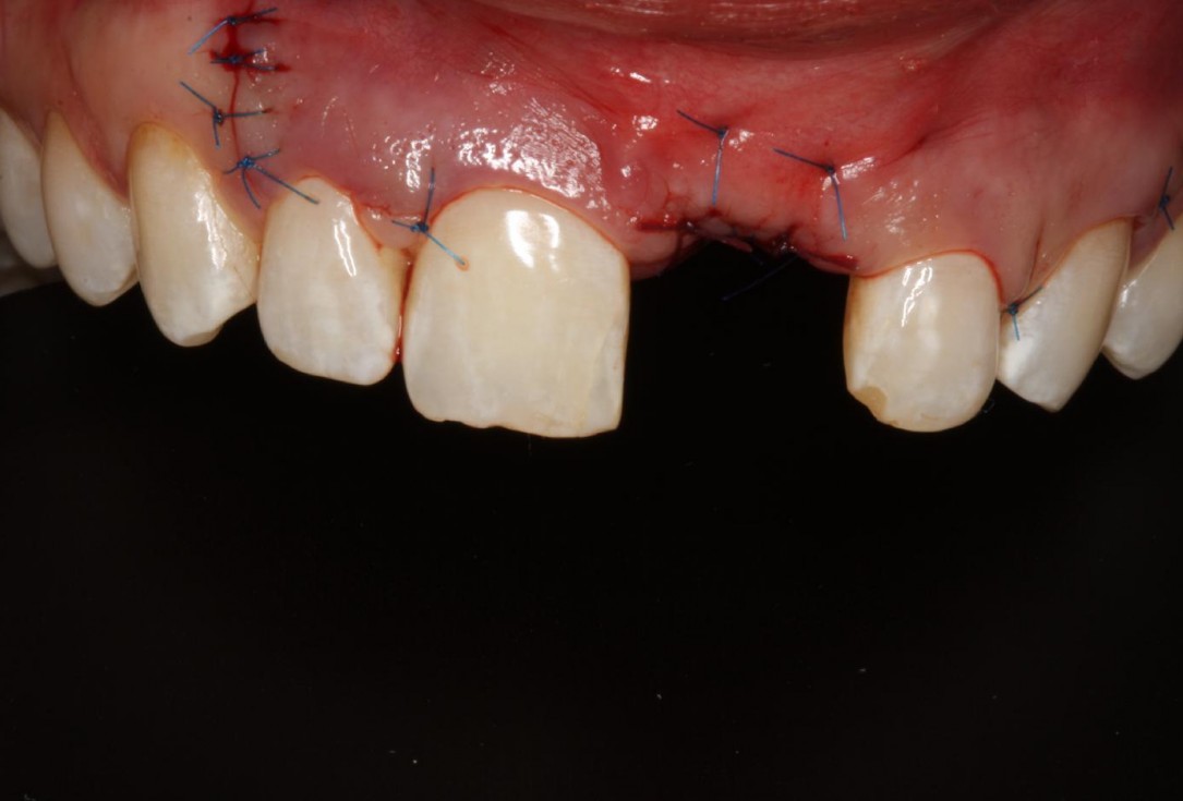 Soft tissue thickening at early implant placement-Puisys